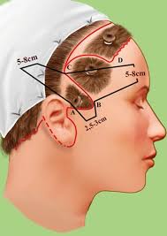 Importance of the Pontes Peninsula in Rhytidoplasty