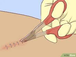 Chirurgische Klammern Entfernen 8 Schritte Mit Bildern Wikihow