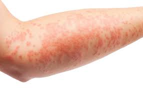 Image result for Atopic Dermatitis