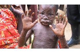 The incubation period (interval from infection to onset of symptoms) of monkeypox is usually from 6 to 13 days but can range from 5 to 21 days. Goodbye Smallpox Vaccination Hello Monkeypox Discover Magazine