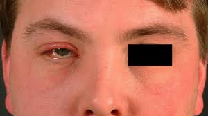 A., qureshi t., ali s., ayub b. Solid Facial Edema In Rosacea Altmeyers Encyclopedia Department Dermatology