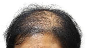 Now avail up to 50 % off on oliva's prp hair loss treatment! Hair Loss Dermatology Co Dermatology Co