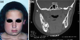 Craniofacial disorders