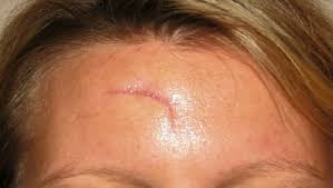 Scars on the face are perhaps the most upsetting places to have scars. 20 Super Effective Home Remedies To Get Rid Of Stubborn Old Scars