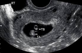 You will have to wait a little longer till it develops more, and has. Normal 1st Trimester Ultrasound How To