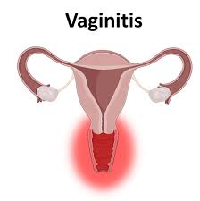 Image result for Vaginitis