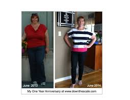 Yes A Year Makes A Difference 96 5 Pounds Are Gone Sleeve Surgery Gastric Sleeve Gastric Sleeve Surgery