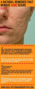 Pin On Acne Scars Treatment