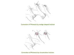 Image result for Phimosis