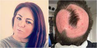 Ppd is a chemical that's also found in temporary tattoo. This Mom Tried To Diy Pastel Locks But Ended Up Losing Her Hair Instead Hair Horror Stories