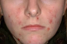 You need to take a leaf of aloe vera plant, extract the gel from aloe vera leaves and then apply the gel all over the acne scabs. Howto How To Get Rid Of Acne Scabs Overnight