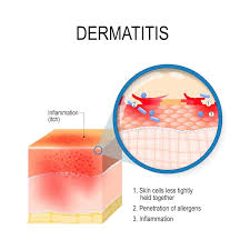 Image result for contact dermatitis