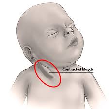 Torcicollo nei bambini: l'aiuto arriva dall'osteopatia