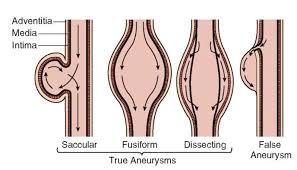 Hesi Case Studies Aneurysm Aortic Aneurysm Nursing Notes