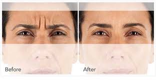 The effect from botox injection usually lasts about three to six months. How Botox Cervical Dystonia Treatment Will Benefits You