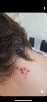 Dans une vidéo, l'équipe de navalny présentait un « palais de poutine » aux pièces luxueuses, reconstituées au moyen d'images numériques. Etrange Bouton Rouge Nuque Forum Dermatologie Journal Des Femmes