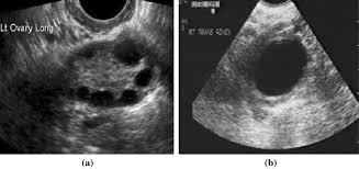 Authored by elisa ross, md and chelsea fortin, md of the for the vast majority of women, ovarian cysts are not precancerous lesions and do not increase the risk of developing ovarian cancer later in life. Detection Of Ovarian Cyst In Ultrasound Images Using Fine Tuned Vgg 16 Deep Learning Network Springerlink