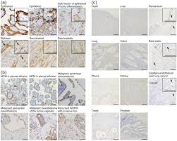 Malignant mesothelioma is a rare form of cancer caused by asbestos. Heg1 Is A Novel Mucin Like Membrane Protein That Serves As A Diagnostic And Therapeutic Target For Malignant Mesothelioma Scientific Reports