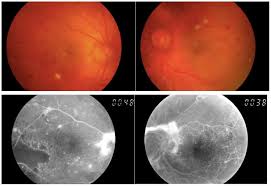 Diyabetik Retinopati Prof Dr Yuksel Totan