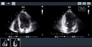 Lvivo Ef Comparable To Mri Contrast Echo In Assessing