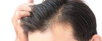 For ways to stop hair loss please visit our website for more information. Differences Between Dutasteride Vs Finasteride Limmer Htc