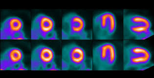 In a stress test, you walk on a treadmill that makes your heart work progressively harder. Myocardial Perfusion Pet Stress Test Cedars Sinai