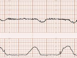 Image result for Contraction Stress Test