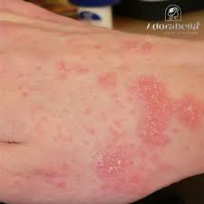 Image result for scabies human bites