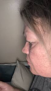 EYES: I've had a condition called nocturnal lagophthalmos since I was a kid  which means that when I sleep, my eyes remain slightly open and the lids do  not fully close. (Kinda