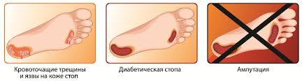 Porazheniya Kozhi Pri Saharnom Diabete Prichiny Diagnostika I Lechenie
