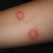 If you notice a circular rash on yourself or a child, a visit to the doctor for an accurate. How To S Wiki 88 How To Get Rid Of Ringworm Marks Permanently