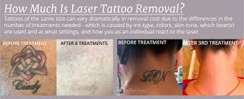 Our payment options include cash, checks,. Reducing The Cost Of Tattoo Removal How To Maximize Your Laser Tattoo Removal Treatments Results Reflections Center