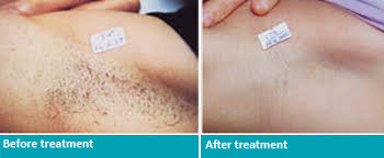 It's also ideal for treating multiple areas, like the bikini area and underarms. Laser Hair Removal Montclair Nj Permanent Hair Removal