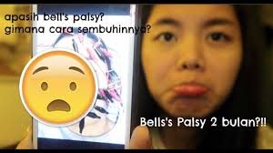 Ikuti keterangan lanjut oleh ahli fisioterapi kami dalam mengupas topik. Apa Itu Bell S Palsy 2 Bulan Baru Sembuh Ceritanini Youtube