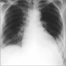 L'embolia polmonare rappresenta la terza causa di patologia cardiovascolare dopo l'infarto miocardico e l'ictus cerebrale. Leadership Medica L Approccio Clinico Diagnostico Al Paziente Con Embolia Polmonare