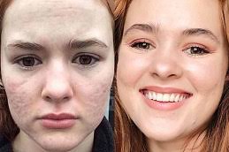 Best Acne Scars Treatment in Dubai UAE & Abu Dhabi | Acne Scar Cost