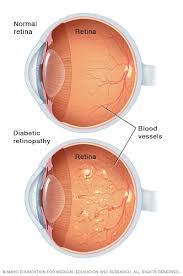 People living with diabetes should have eye screening as part of their diabetes checks. Diabetic Retinopathy Symptoms And Causes Mayo Clinic