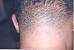 Folliculitis Keloidalis Cure