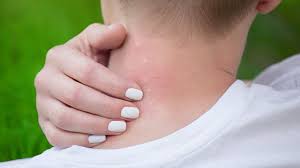 The bite site will be cleaned. 10 Home Remedies That Help Heal Spider Bites Naturally Top 10 Home Remedies