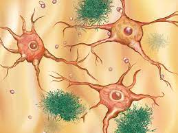 Use them in commercial designs under lifetime, perpetual & worldwide rights. Illustration Amyloide Plaques Und Fibrillen Alzheimer Forschung Initiative E V Afi