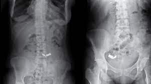 Maybe you would like to learn more about one of these? Accidental Ingestion Of A Dental Bridge