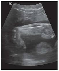 Talipes is also known as club foot. Ponseti Casting Musculoskeletal Key