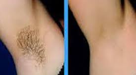 Some rules are not meant to be broken, niki says. Laser Hair Removal Bloom Laser Clinic