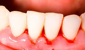We did not find results for: Types Of Gingivitis St Lawrence Dentistry