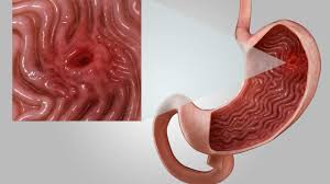 9 Serious Conditions That Can Feel Like Heartburn Stomach Ulcers Peptic Ulcer Ulcers