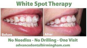 This can include illnesses and infections, vitamin deficiencies, excess fluoride, and even trauma to the tooth. What Are White Spots On Teeth And What Can You Do About Them Advance Dental Pc Dentist Birmingham Al