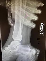 Image result for Ankle XRay
