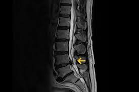 Spinalkanalstenose Gemeinschaftspraxis Fur Neurochirurgie