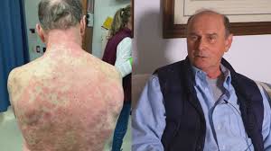 A new study finds some of them, including covid toes, a measleslike rash and shingles also can be rare, and thankfully brief, side. Goochland County Man Suffers Rare Severe Reaction To Covid 19 Vaccine 8news