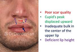 Image result for Cleft Lip
